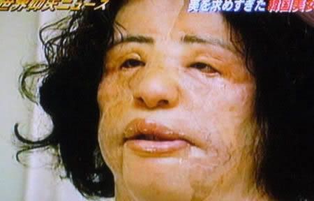 Injecting Cooking Oil Into Her Face. cooking oil into her face.